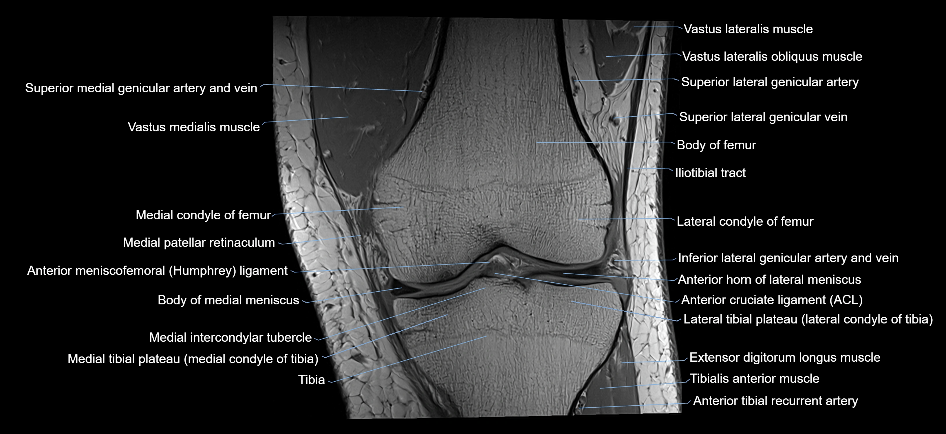 MRI knee coronal cross sectional anatomy labelled 3T radiology  image-04001-00018.webp